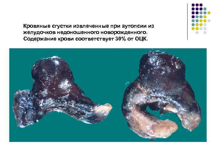 Кровяные сгустки извлеченные при аутопсии из желудочков недоношенного новорожденного. Содержание крови соответствует 30% от Кровяные сгустки извлеченные при аутопсии из желудочков недоношенного новорожденного. Содержание крови соответствует 30% от
