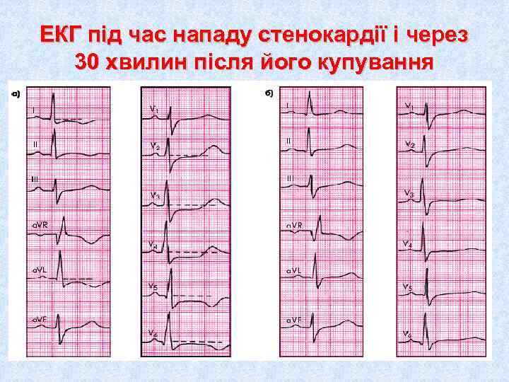 ЕКГ під час нападу стенокардії і через  30 хвилин після його купування 