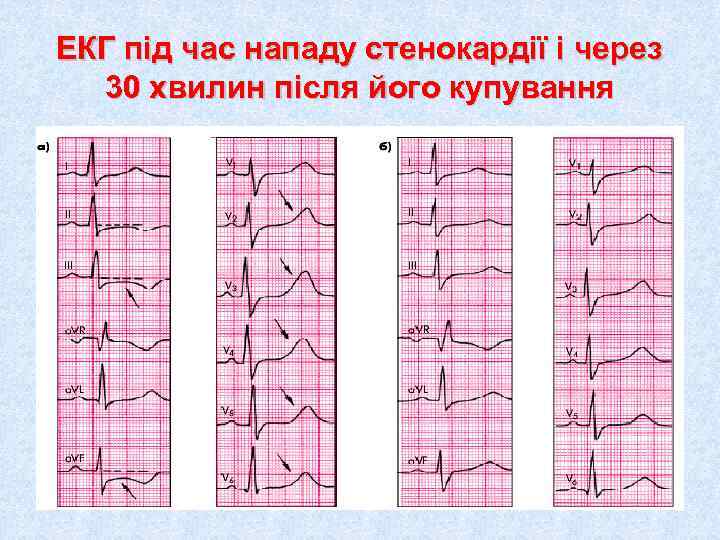 ЕКГ під час нападу стенокардії і через  30 хвилин після його купування 