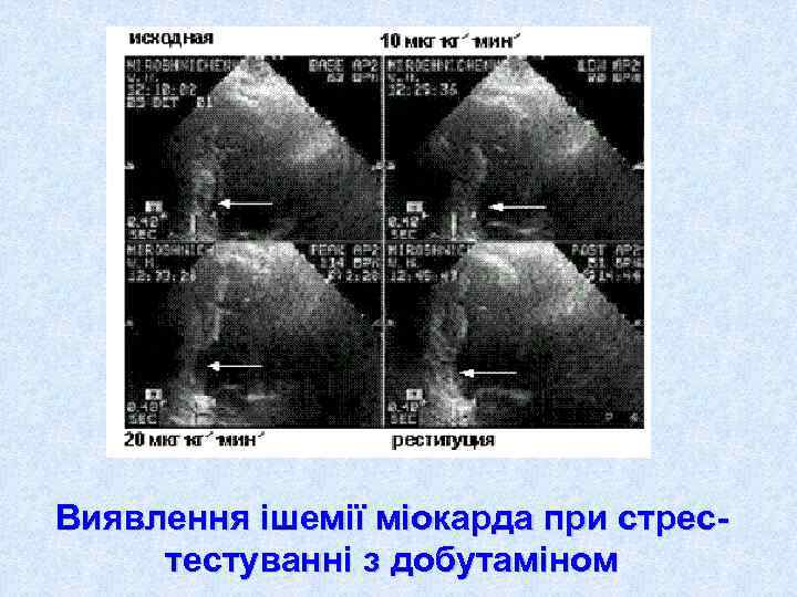 Виявлення ішемії міокарда при стрес- тестуванні з добутаміном 