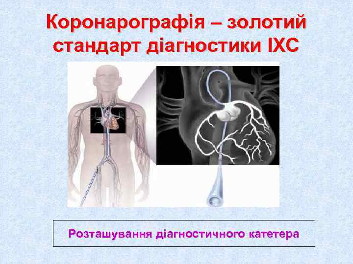 Коронарографія – золотий стандарт діагностики ІХС  Розташування діагностичного катетера 