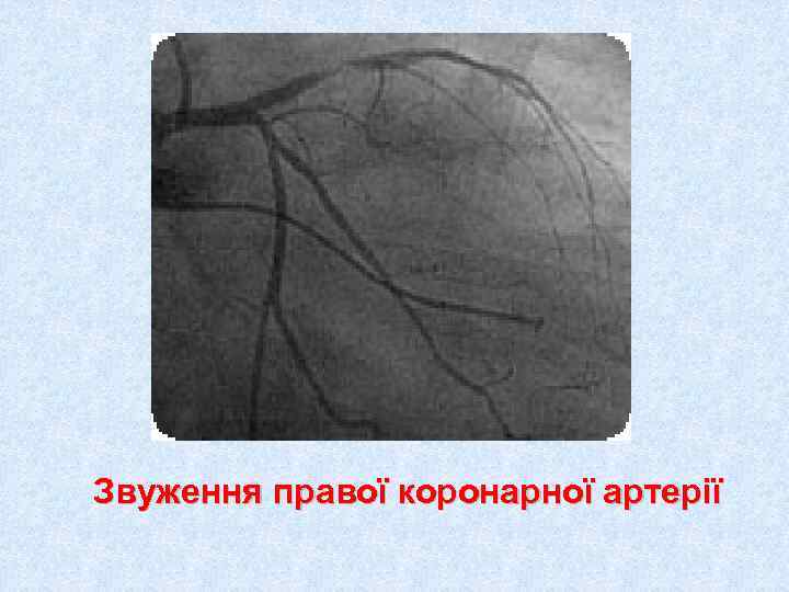 Звуження правої коронарної артерії 