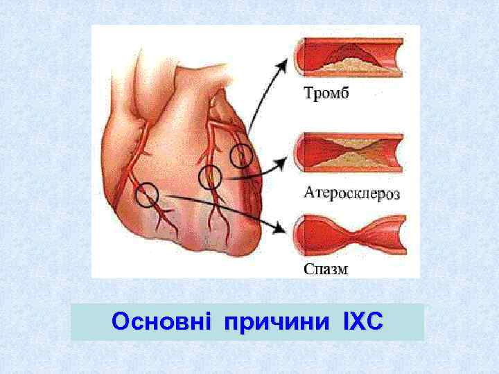 Основні причини ІХС 