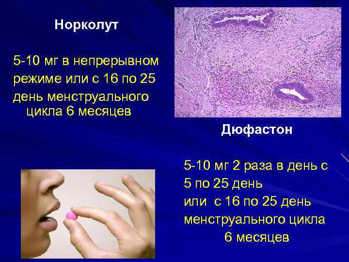  Норколут 5 -10 мг в непрерывном режиме или с 16 по 25 день