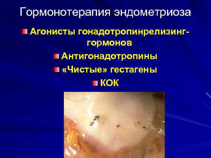 Гормонотерапия эндометриоза Агонисты гонадотропинрелизинг-   гормонов  Антигонадотропины   «Чистые» гестагены 