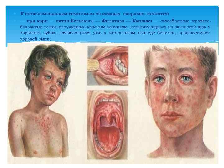  К патогномоничным симптомам на кожных покровах относятся:  — при кори — пятна
