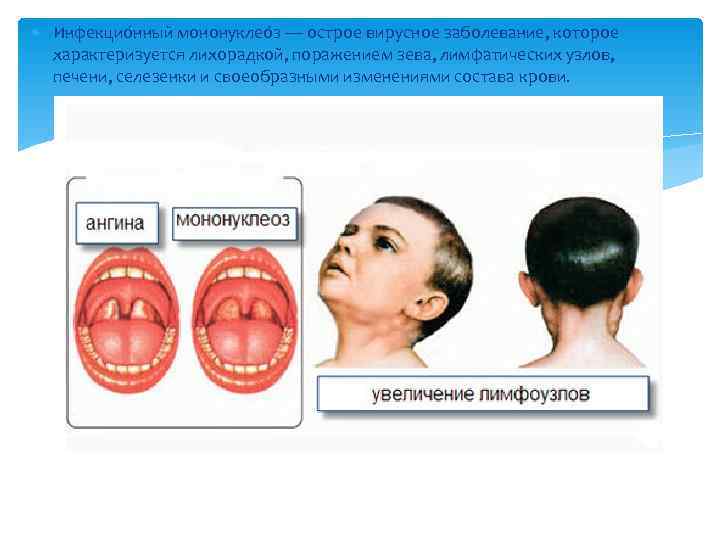  Инфекцио нный мононуклео з — острое вирусное заболевание, которое  характеризуется лихорадкой, поражением