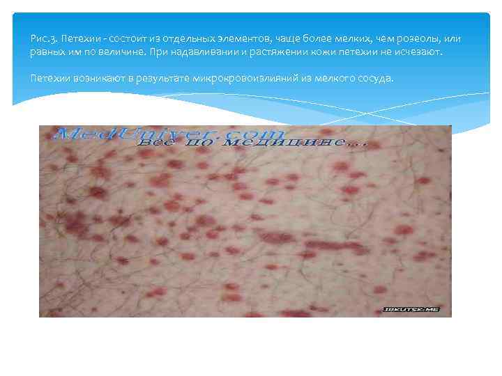 Рис. 3. Петехии  состоит из отдельных элементов, чаще более мелких, чем розеолы, или