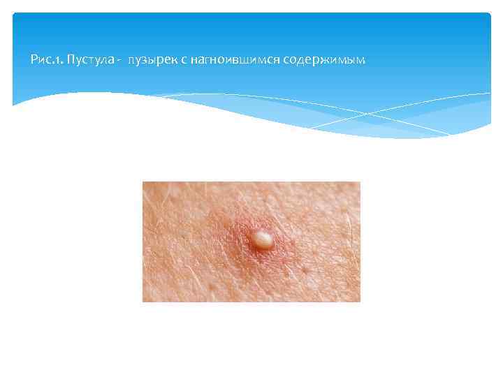     Рис. 1. Пустула  пузырек с нагноившимся содержимым 