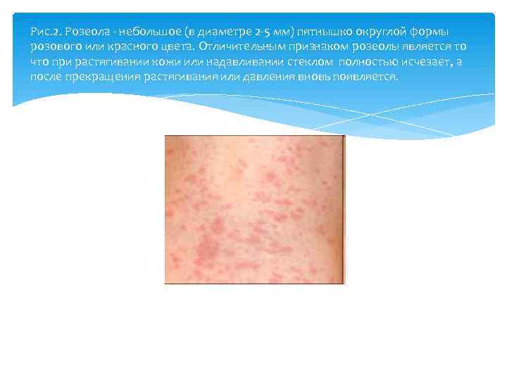 Рис. 2. Розеола  небольшое (в диаметре 2 5 мм) пятнышко округлой формы розового