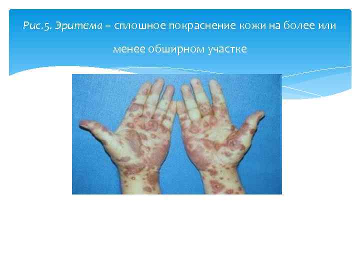 Рис. 5. Эритема – сплошное покраснение кожи на более или   менее обширном