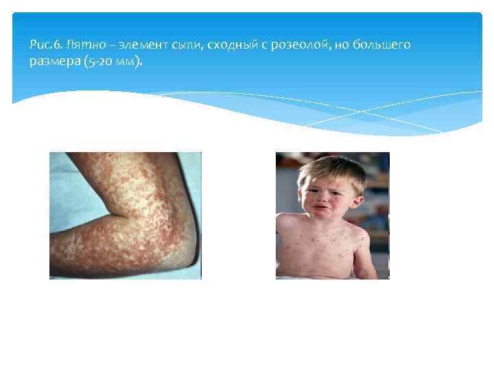Рис. 6. Пятно – элемент сыпи, сходный с розеолой, но большего размера (5 20