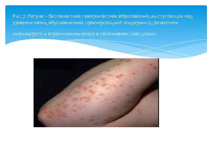 Рис. 7. Папула – бесполостное поверхностное образование, выступающее над уровнем кожи, обусловленное пролиферацией эпидермиса,