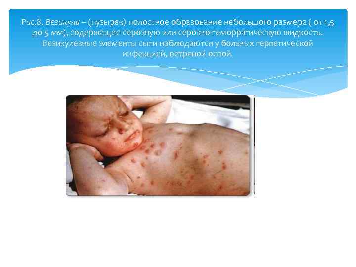 Рис. 8. Везикула – (пузырек) полостное образование небольшого размера ( от 1, 5 