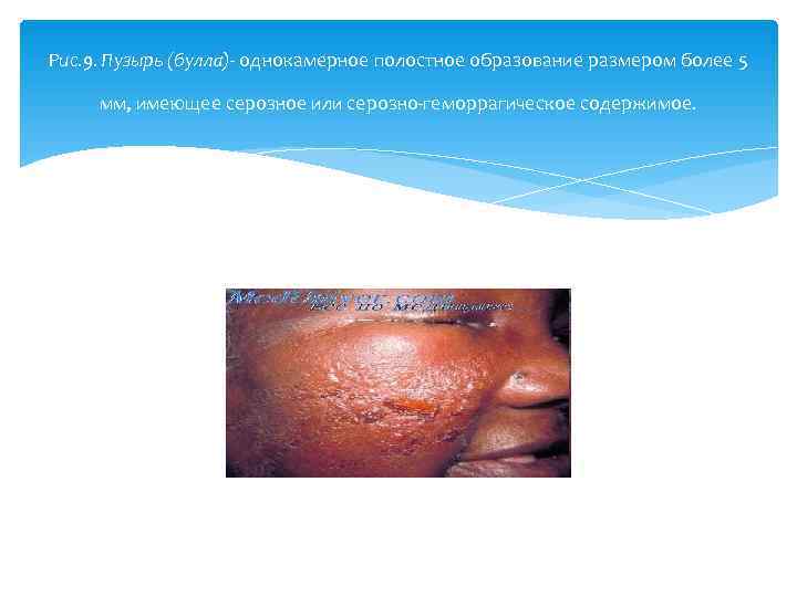 Рис. 9. Пузырь (булла) однокамерное полостное образование размером более 5  мм, имеющее серозное