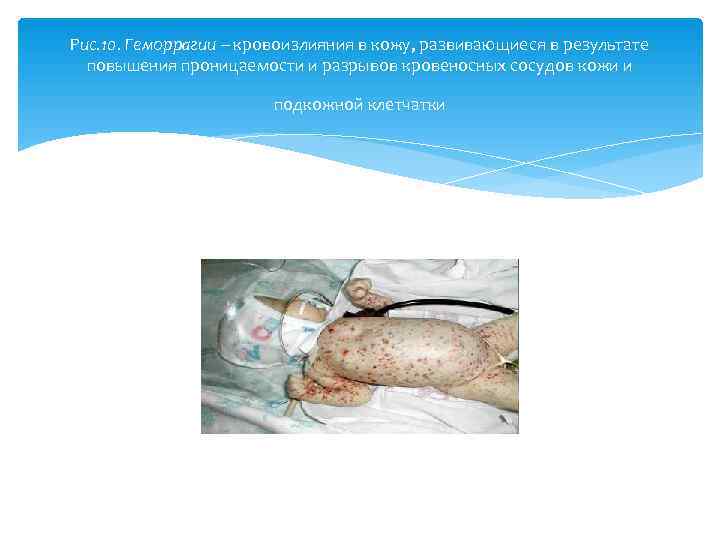 Рис. 10. Геморрагии – кровоизлияния в кожу, развивающиеся в результате  повышения проницаемости и