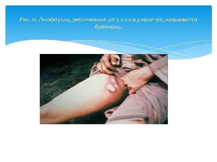 Рис. 11. Лимфоузлы, увеличенные до 3 5 см в диаметре, называются   