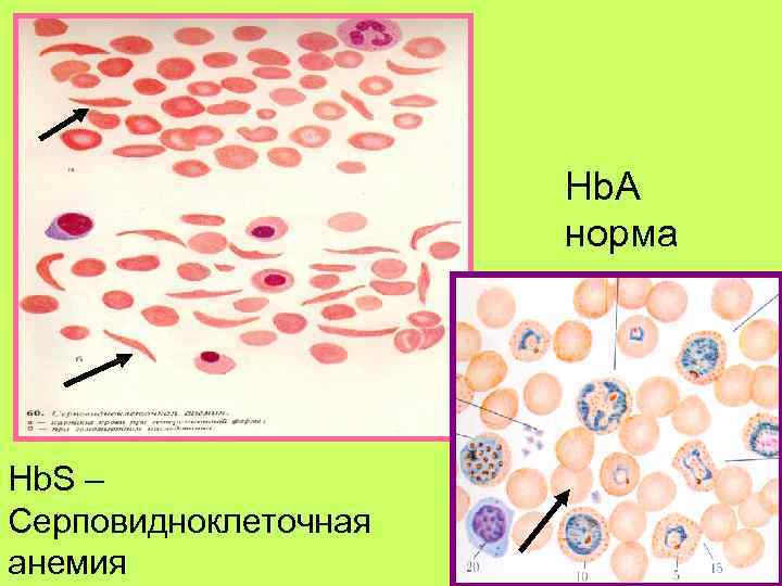      Hb. A    норма Hb. S –