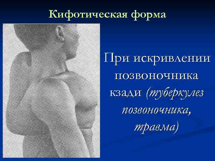 Кифотическая форма  При искривлении  позвоночника   кзади (туберкулез  позвоночника, 