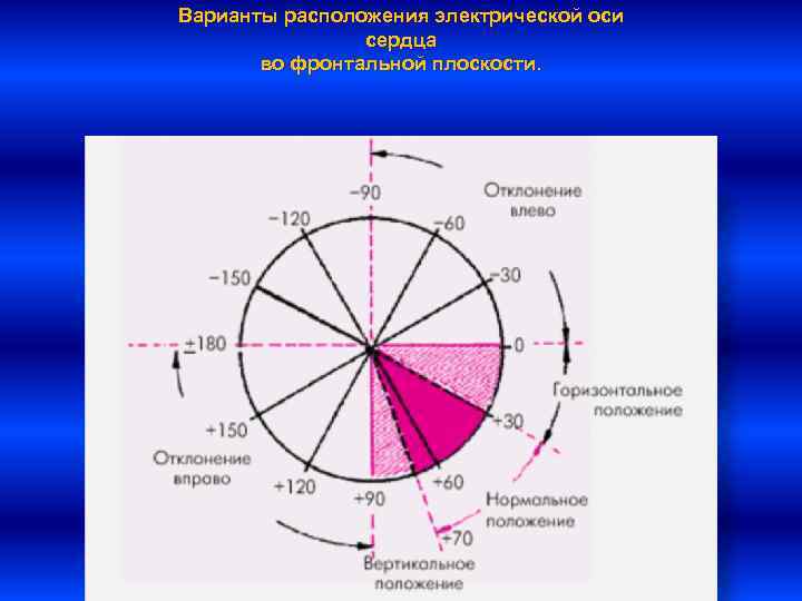 Варианты расположения электрической оси   сердца  во фронтальной плоскости. 