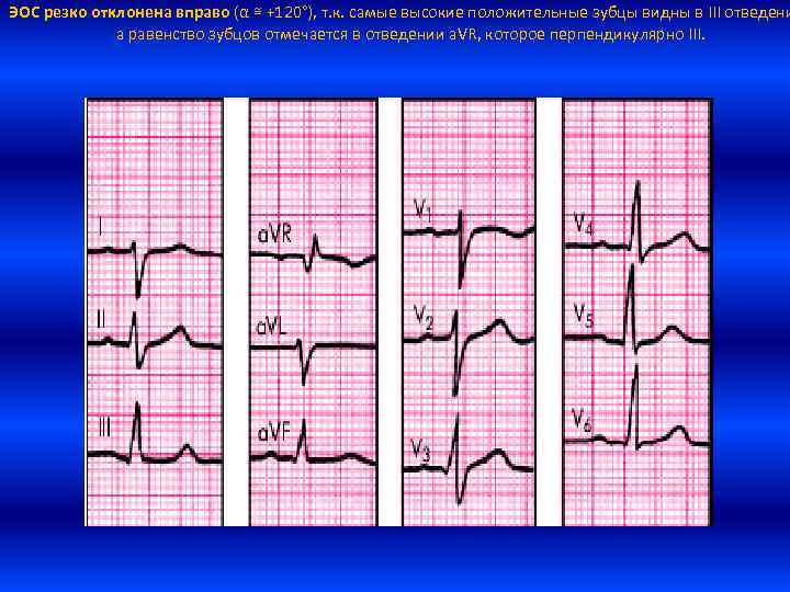 Эос отклонена вправо. Зубец т на ЭКГ норма. Отклонение вправо на ЭКГ. Отклонение оси вправо на ЭКГ. Электрическая ось вправо на ЭКГ.