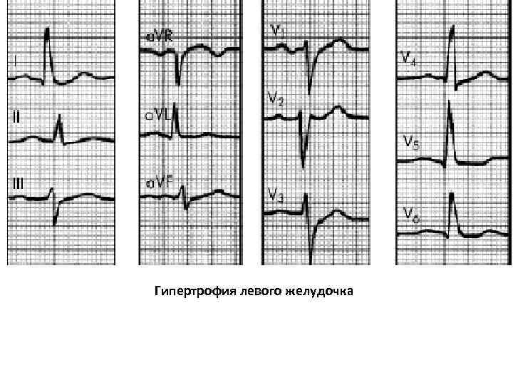 Гипертрофия левого желудочка 