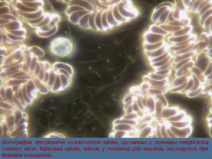 Фотографии эритроцитов человеческой крови, сделанные с помощью микроскопа темного поля. Капелька крови, взятая у