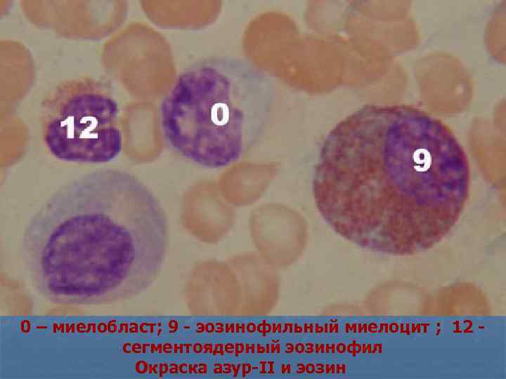 0 – миелобласт; 9 - эозинофильный миелоцит ; 12 - сегментоядерный эозинофил Окраска азур-II