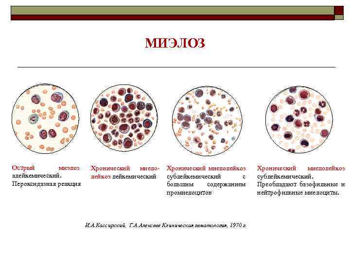 МИЭЛОЗ Острый миэлоз алейкемический. Пероксидазная реакция Хронический миелолейкоз лейкемический Хронический миелолейкоз сублейкемический с большим