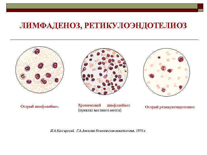 ЛИМФАДЕНОЗ, РЕТИКУЛОЭНДОТЕЛИОЗ Острый лимфолейкоз. Хронический лимфолейкоз (пунктат костного мозга) Острый ретикулоэндотелиоз И. А. Кассирский,