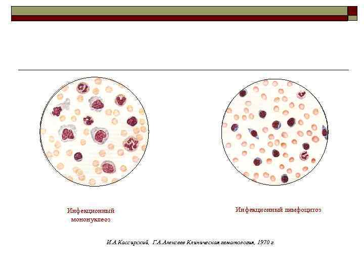 Инфекционный мононуклеоз Инфекционный лимфоцитоз И. А. Кассирский, Г. А. Алексеев Клиническая гематология, 1970 г.