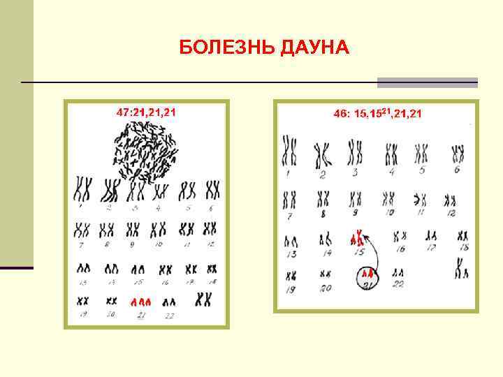 БОЛЕЗНЬ ДАУНА 