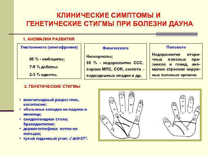    КЛИНИЧЕСКИЕ СИМПТОМЫ И  ГЕНЕТИЧЕСКИЕ СТИГМЫ ПРИ БОЛЕЗНИ ДАУНА  1.