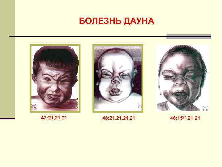    БОЛЕЗНЬ ДАУНА 47: 21, 21  48: 21, 21, 21 