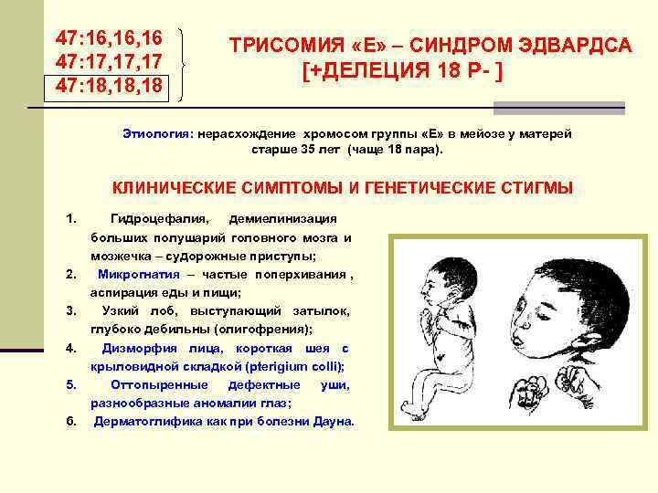 47: 16, 16    ТРИСОМИЯ «Е» – СИНДРОМ ЭДВАРДСА 47: 17, 17