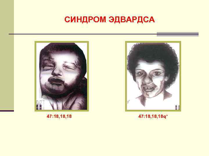   СИНДРОМ ЭДВАРДСА 47: 18, 18   47: 18, 18 q+ 