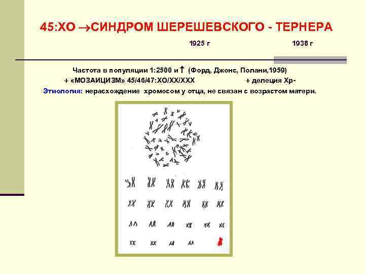 45: ХО СИНДРОМ ШЕРЕШЕВСКОГО - ТЕРНЕРА       1925 г