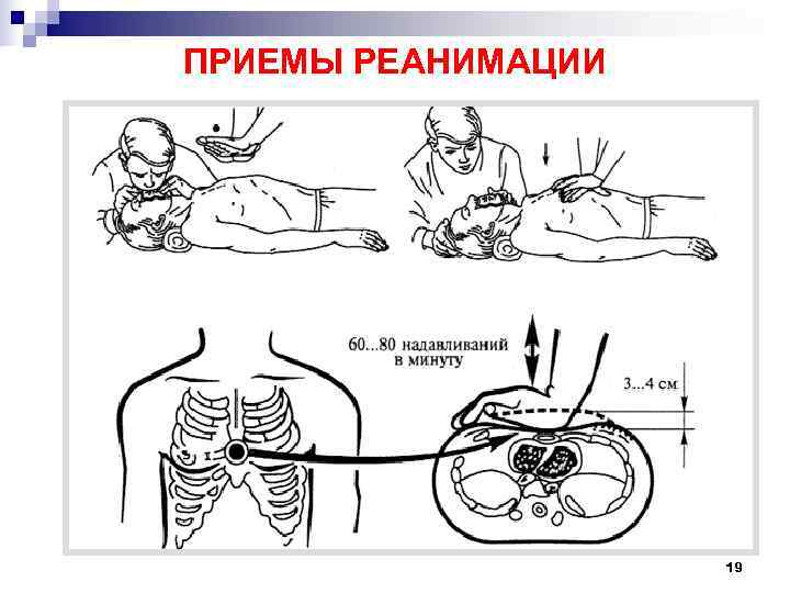 ПРИЕМЫ РЕАНИМАЦИИ     19 