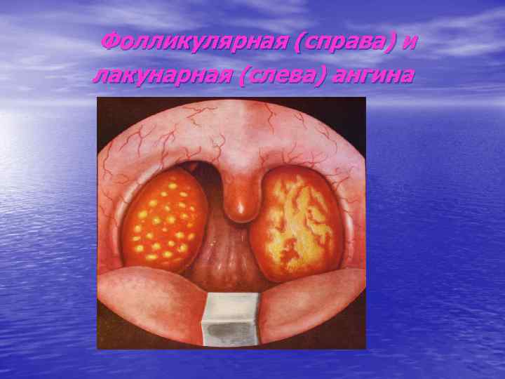 Фолликулярная (справа) и лакунарная (слева) ангина 