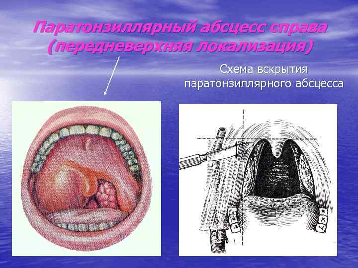 Паратонзиллярный абсцесс справа (передневерхняя локализация) Схема вскрытия паратонзиллярного абсцесса 