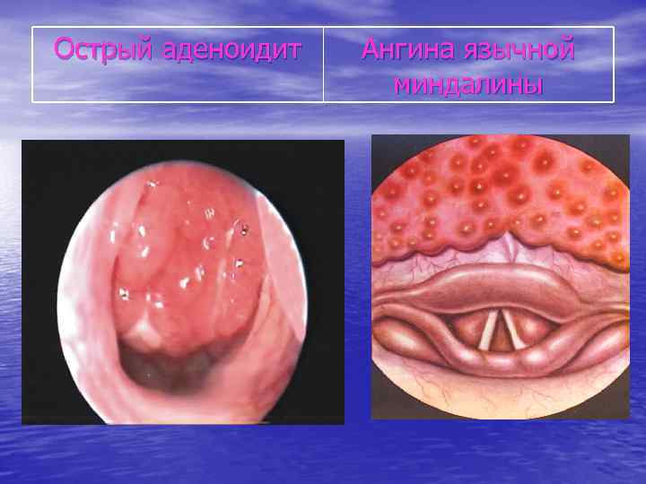 Острый аденоидит Ангина язычной миндалины 
