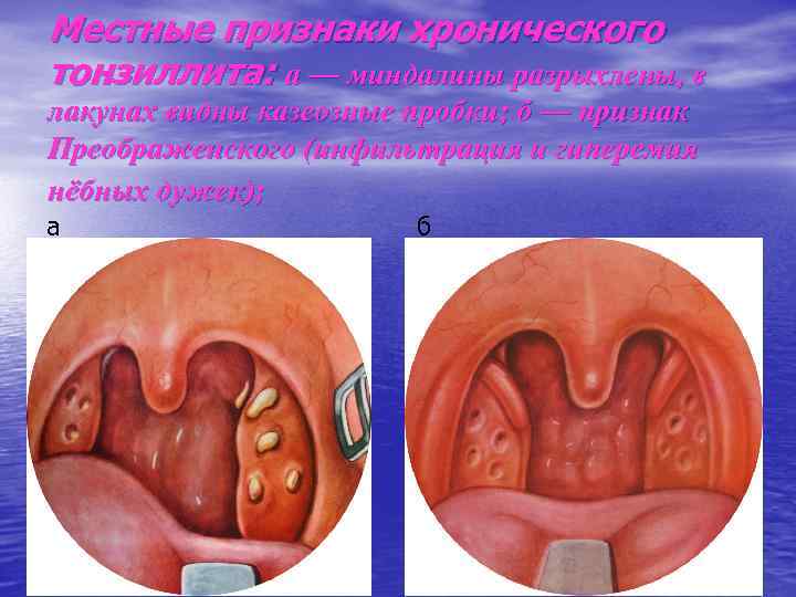 Местные признаки хронического тонзиллита: а — миндалины разрыхлены, в лакунах видны казеозные пробки; б