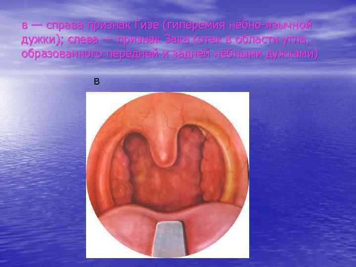 в — справа признак Гизе (гиперемия нёбно-язычной дужки); слева — признак Зака (отек в