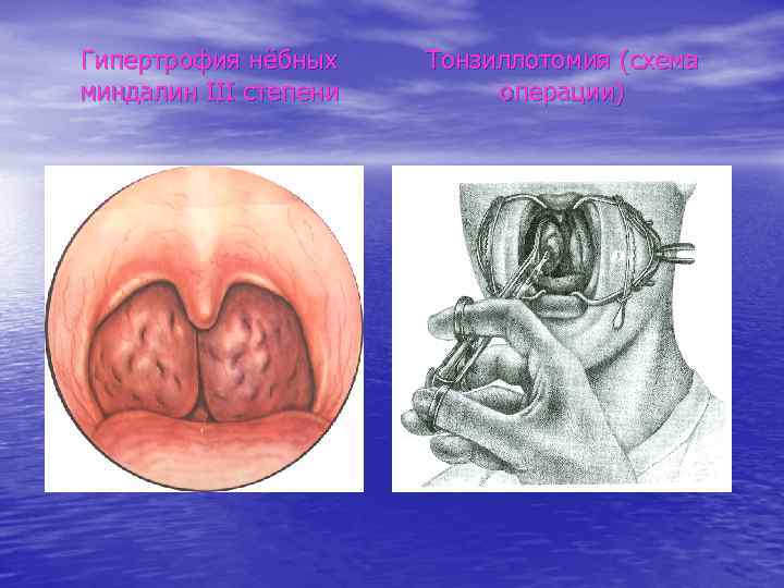 Гипертрофия нёбных миндалин III степени Тонзиллотомия (схема операции) 