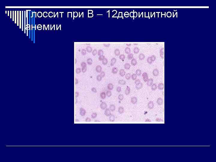 Глоссит при В – 12 дефицитной анемии 