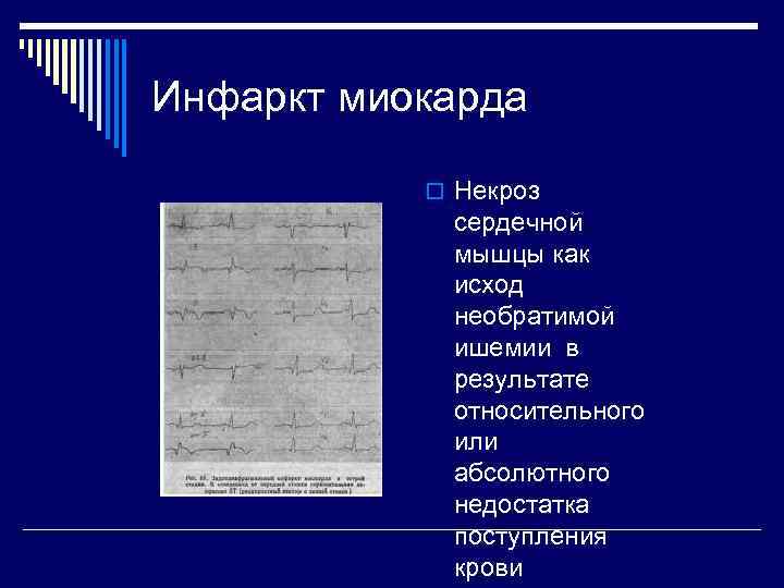 Инфаркт миокарда   o Некроз   сердечной   мышцы как 