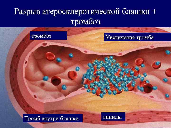 Разрыв атеросклеротической бляшки +    тромбоз      Увеличение