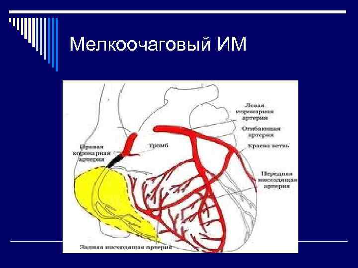 Мелкоочаговый ИМ 
