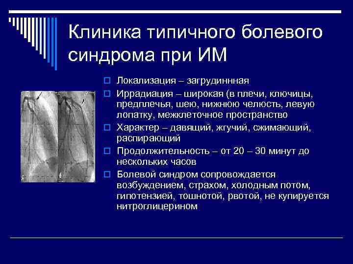 Клиника типичного болевого синдрома при ИМ  o Локализация – загрудиннная  o Иррадиация