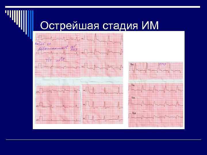 Острейшая стадия ИМ 